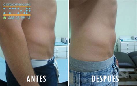 Infografía mostrando cómo la carboxiterapia actúa sobre la grasa localizada y la flacidez en el abdomen.