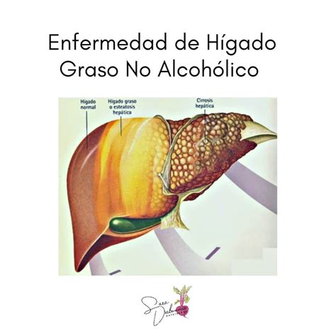 Diagrama del hígado mostrando la acumulación de grasa en la EHGNA.