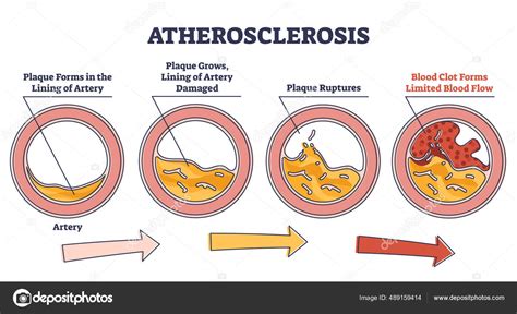 Ilustración que muestra la progresión de la aterosclerosis, desde la acumulación de LDL en la pared arterial hasta la formación de una placa y la posible obstrucción del flujo sanguíneo.