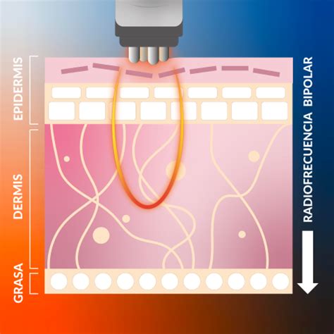 Diagrama que ilustra cómo las ondas de radiofrecuencia penetran en la dermis, estimulando la producción de colágeno y elastina.