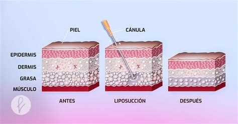 Infografía mostrando los pasos de una liposucción: incisiones, inserción de cánula, succión de grasa y colocación de faja compresora.