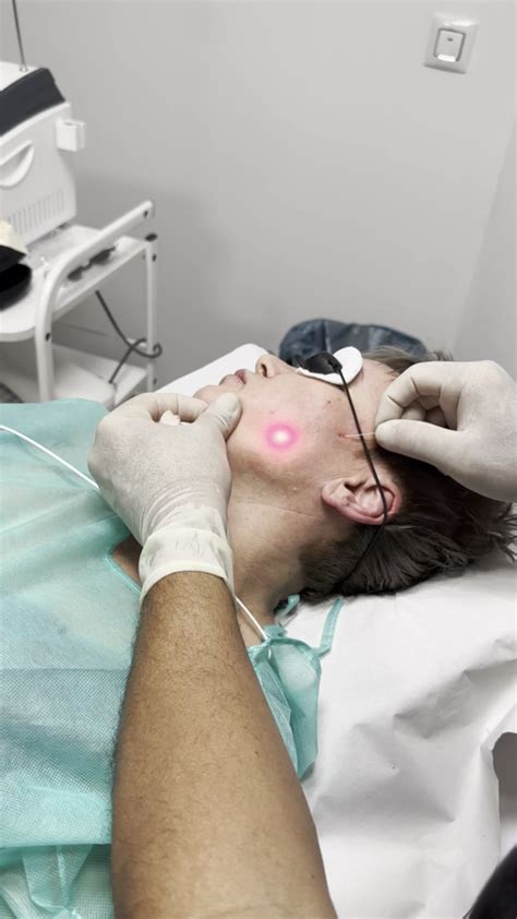 Diagrama del procedimiento de lipoláser facial mostrando la introducción de la fibra óptica y la cánula.