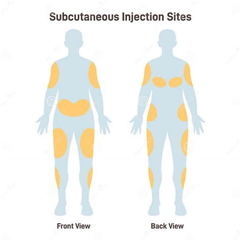Diagrama mostrando los sitios de inyección de Victoza (abdomen, muslo, brazo)