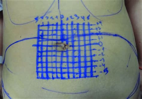 Doctor dibujando marcaje preoperatorio en el abdomen de un paciente, primer plano.