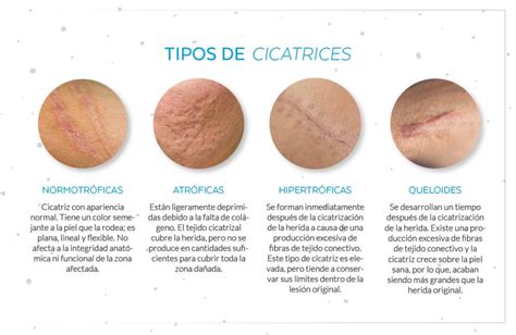 Infografía comparativa de las cicatrices resultantes de los diferentes tipos de abdominoplastia.