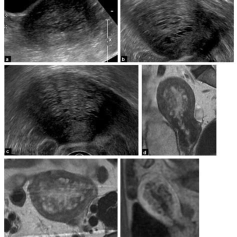 Ecografía transvaginal mostrando características típicas de adenomiosis.