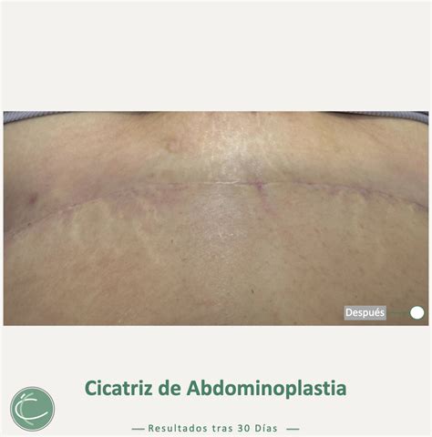 Diseño de la cicatriz de abdominoplastia, mostrando su ubicación horizontal sobre el pubis y su extensión de cadera a cadera.
