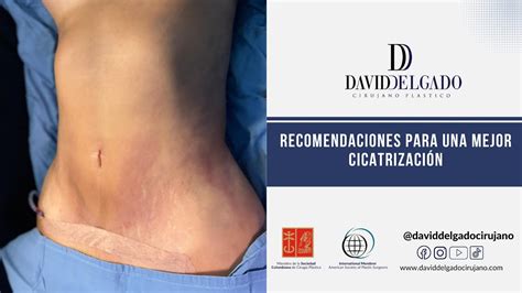 Infografía comparando una cicatriz madura y una inmadura tras abdominoplastia.