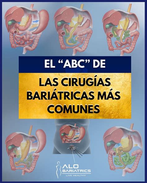 Infografía comparativa de complicaciones comunes en cirugías bariátricas.