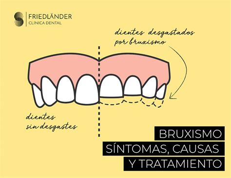 Infografía: Proceso de diagnóstico y tratamiento multidisciplinar para el bruxismo y sus consecuencias.