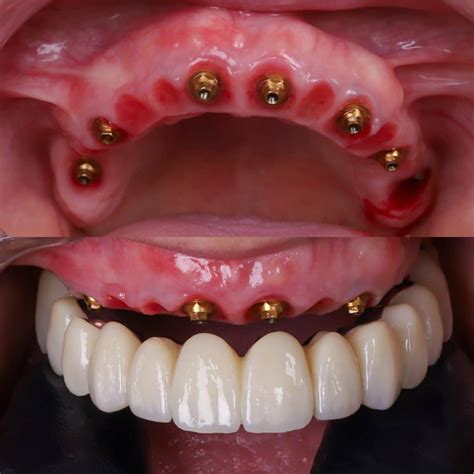 Diagrama comparativo de diferentes materiales para prótesis sobre implantes dentales: metal-porcelana, zirconio, acrílico y composite.