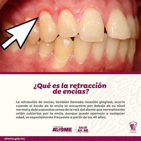 Diagrama que ilustra la retracción de encías, mostrando la pérdida de tejido gingival y la exposición de la raíz dental.