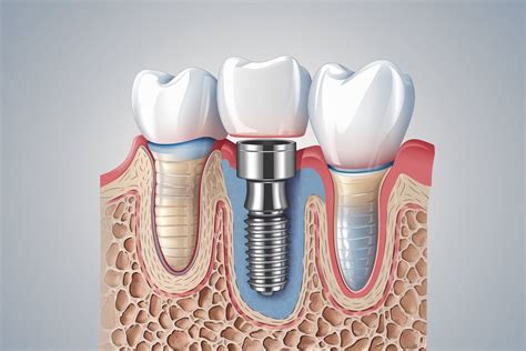 Radiografía dental mostrando un implante y una corona, con posible indicación de un tornillo flojo o periimplantitis.