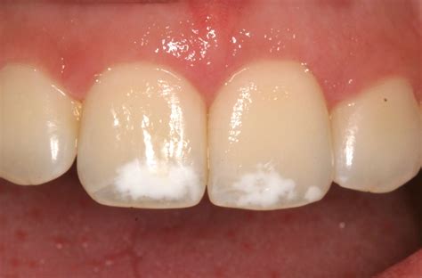 Imagen que muestra dientes con hipoplasia dental, resaltando las manchas y la textura irregular del esmalte.
