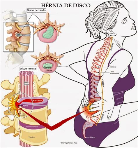 Infografía explicando la anatomía de una hernia discal y cómo afecta a los nervios.
