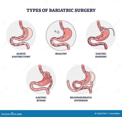 Ilustración de diferentes tipos de procedimientos de cirugía bariátrica.