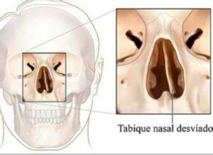 Diagrama que muestra un tabique nasal desviado y cómo la septoplastia lo alinea.