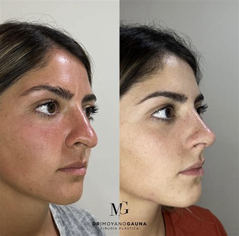 Collage de imágenes mostrando antes y después de diferentes tipos de rinoplastia y liposucción.