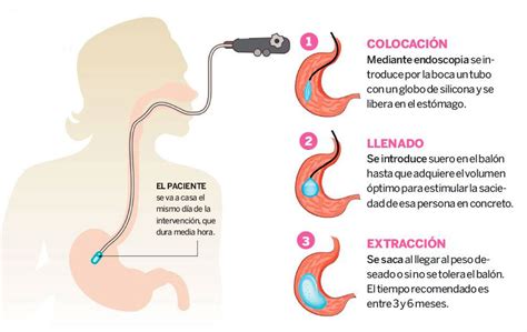 Infografía detallando las fases del tratamiento con balón gástrico: colocación, seguimiento y extracción.