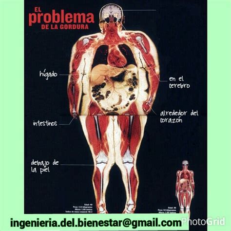 Ilustración esquemática del cuerpo humano con énfasis en el exceso de grasa corporal, representando la definición de obesidad de la OMS.