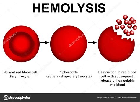 Gráfico comparativo de rendimiento transfusional y hemólisis para concentrados de hematíes jóvenes y viejos