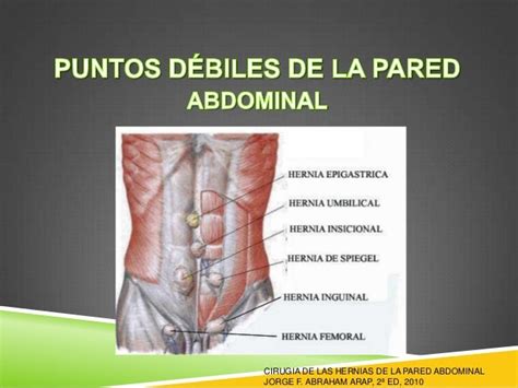 Diagrama que muestra los diferentes tipos de hernias de pared abdominal.