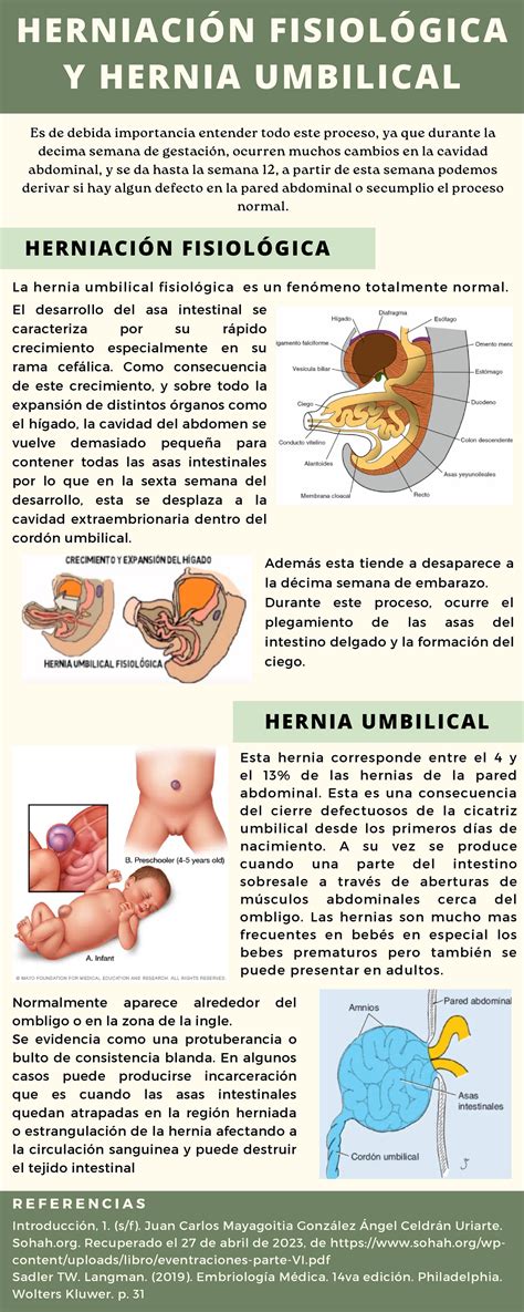Infografía comparativa de hernia inguinal, umbilical y femoral.