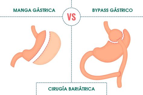 Ilustración comparativa de la manga gástrica y el bypass gástrico.
