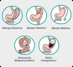 Infografía sobre los beneficios de la cirugía bariátrica en la salud.