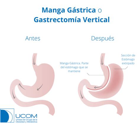 Representación esquemática de la Gastrectomía Vertical (Manga Gástrica), mostrando la porción del estómago que se reseca y la forma tubular resultante.