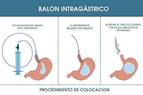 Diagrama de la colocación de un Balón Gástrico