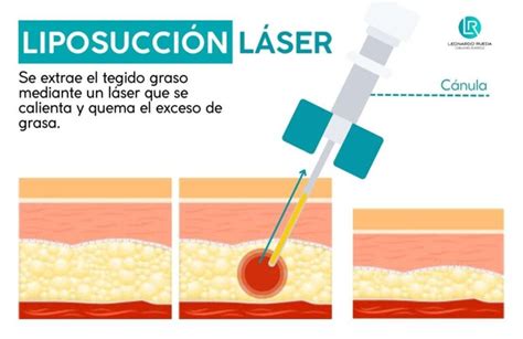 Infografía comparativa de liposucción tradicional y liposucción láser, destacando la retracción de la piel.