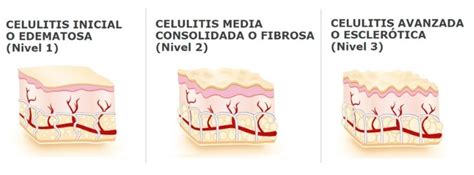 Ilustración comparativa de los tres tipos de celulitis: dura, blanda y edematosa.