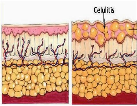 Diagrama ilustrativo de cómo la celulitis afecta las capas de la piel y cómo un masajeador ayuda a mejorar la circulación y el tejido conectivo.