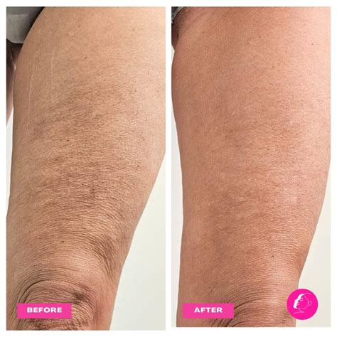 Imagen comparativa: Piernas antes y después de usar mallas con efecto sauna (enfoque en la textura de la piel).