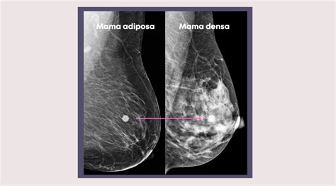 Diseñador: Ilustración anatómica mostrando la compresión del tejido mamario por una faja reductora.