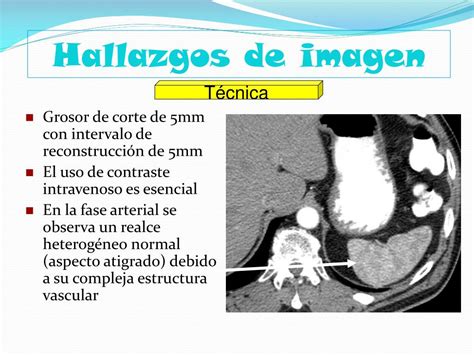 TC de bazo con absceso bacteriano mostrando realce periférico.