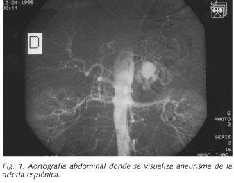 Angiografía por TC mostrando un aneurisma de la arteria esplénica.