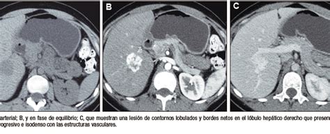 RM de bazo mostrando metástasis hipointensas.