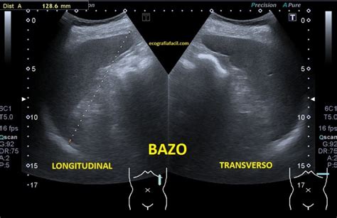 Ecografía de bazo mostrando esplenomegalia.
