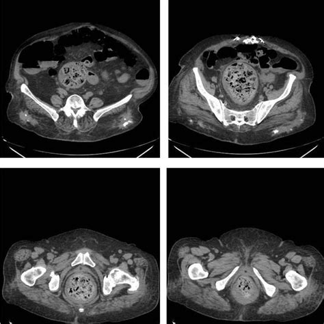 Imagen de TAC que muestra un fecaloma gigante en el colon.
