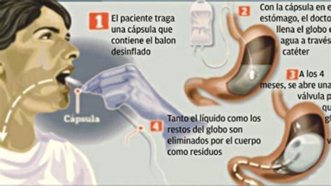 Diagrama del proceso de colocación y funcionamiento de un balón gástrico ingerible.