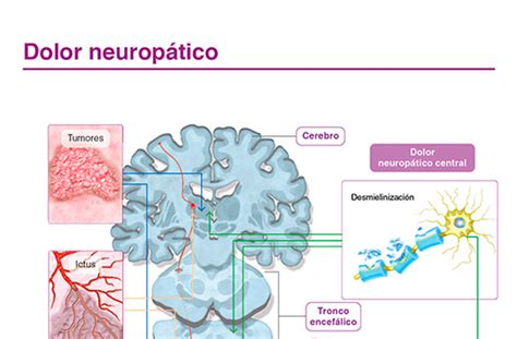Esquema ilustrativo de los mecanismos fisiopatológicos del dolor neuropático.