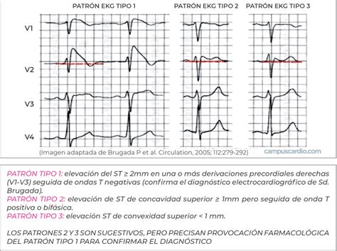 Comparativa de los patrones electrocardiográficos tipo I y tipo II del síndrome de Brugada.