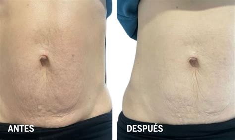 comparativa visual: abdomen antes y después de un tratamiento de abdominoplastia