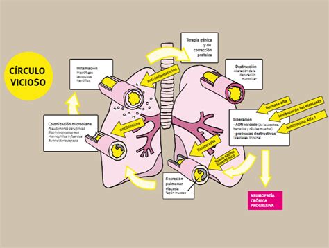 Esquema que ilustra la interconexión entre fibrosis quística, enfermedad hepática y diabetes.