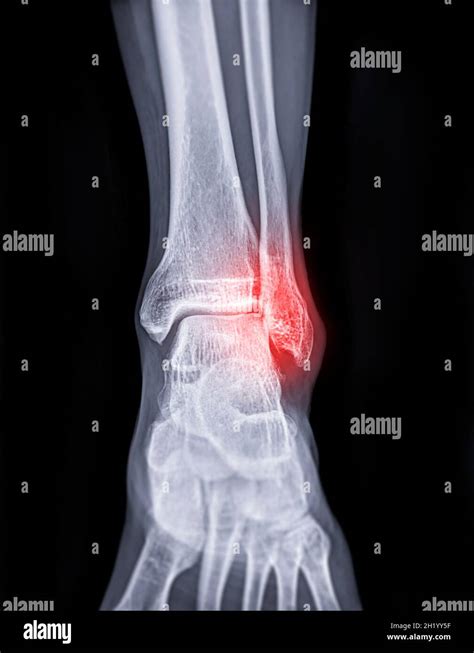 Radiografía de un tobillo mostrando una fractura clara.
