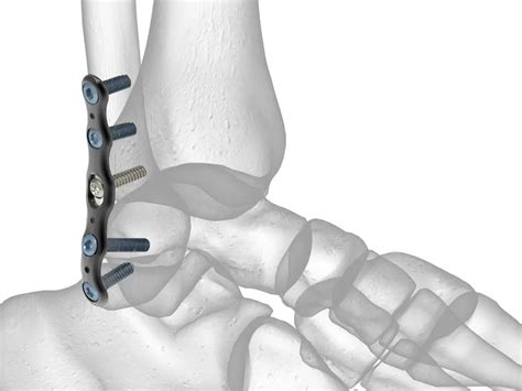 Imagen de una placa y tornillos utilizados en la cirugía de tobillo.