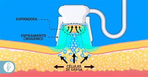 Ilustración del proceso de criolipólisis, mostrando la aplicación de frío en la zona de tratamiento.