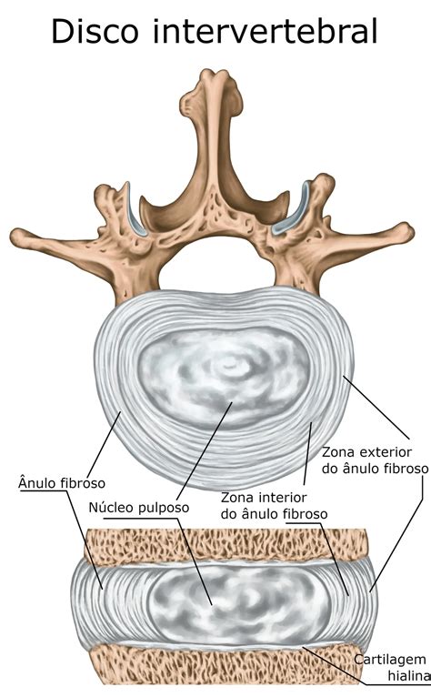 Ilustración de la columna vertebral mostrando un disco abultado o herniado.
